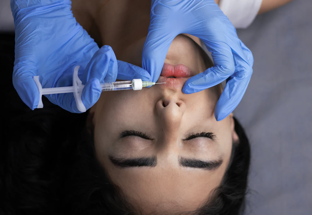 Injection d'acide hyaluronique dans les lèvres, réalisée par un médecin ganté
